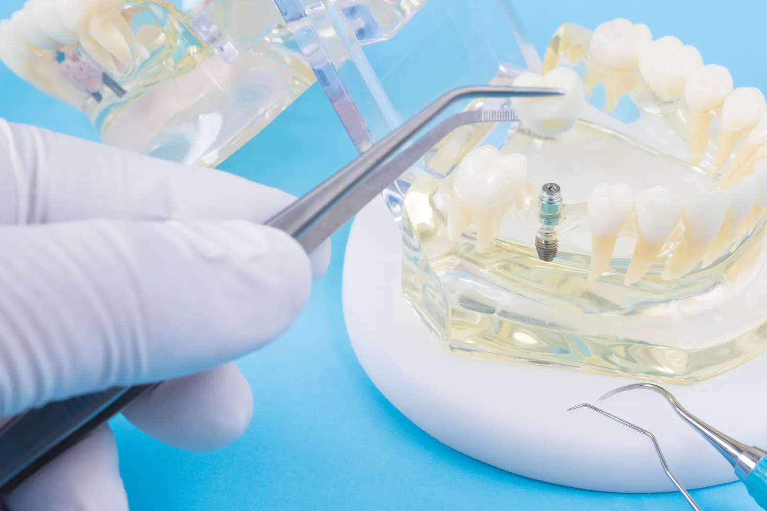 Ile trwa odbudowa kości pod implanty?