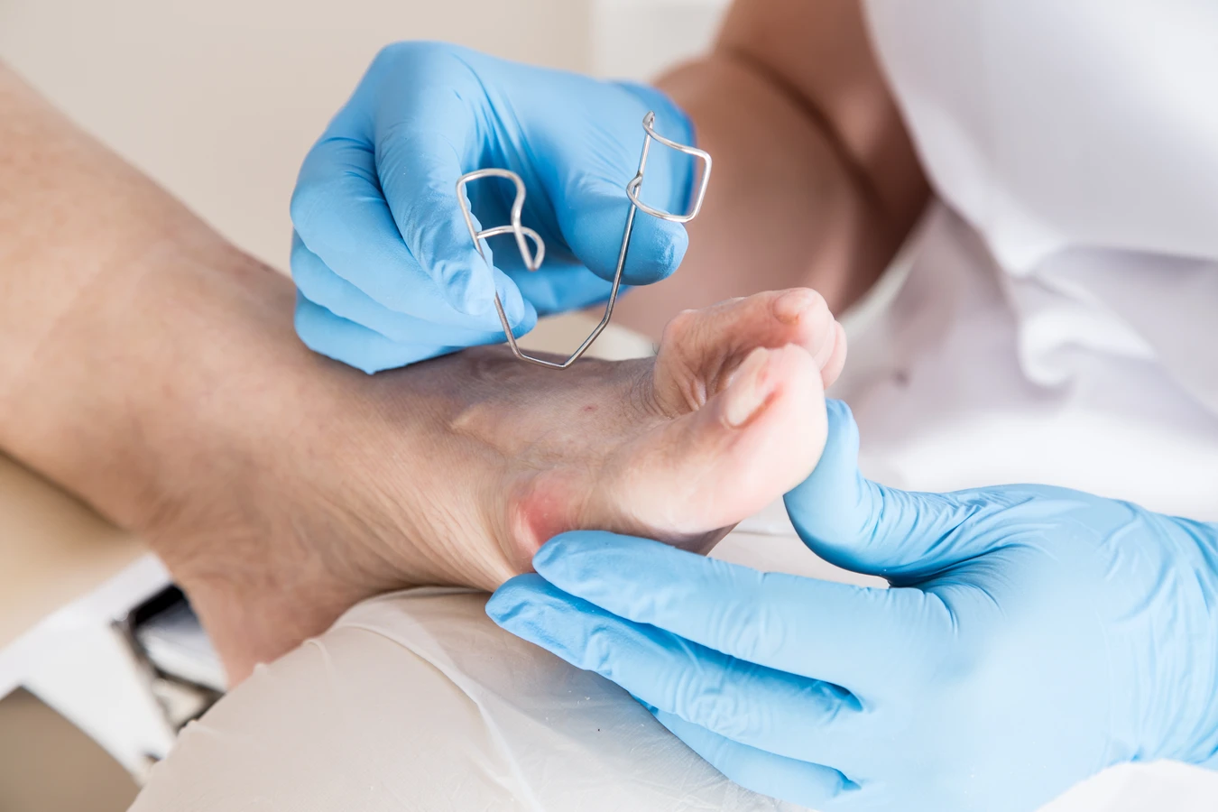 Modzele na stopach - sprawa dla podologa