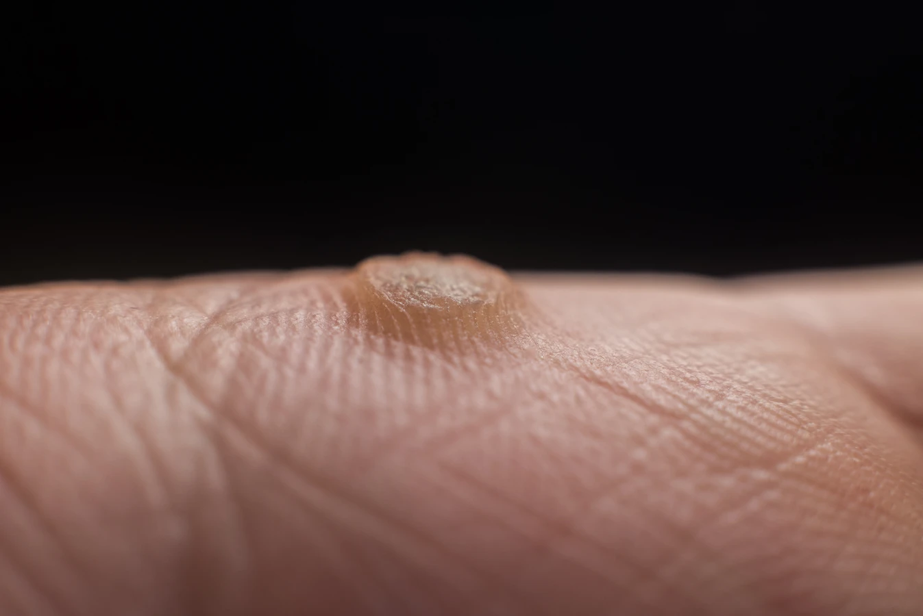 Co stosować na kurzajki?